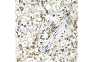 Immunohistochemistry of paraffin-embedded human kidney cancer using ASPSCR1 antibody at dilution of 1:100 (x400 lens). (ASPSCR1 抗体)