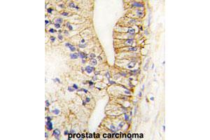 Formalin-fixed and paraffin-embedded human prostate carcinomareacted with CDH7 polyclonal antibody , which was peroxidase-conjugated to the secondary antibody, followed by AEC staining. (Cadherin 7 抗体  (N-Term))