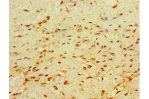 Immunohistochemistry of paraffin-embedded human breast cancer using ABIN7147714 at dilution of 1:100