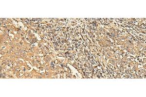 Immunohistochemistry of paraffin-embedded Human cervical cancer tissue using RPS28 Polyclonal Antibody at dilution of 1:30(x200) (RPS28 抗体)