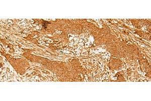 Immunohistochemistry of paraffin-embedded Human ovarian cancer tissue using GTF3C3 Polyclonal Antibody at dilution of 1:30(x200)