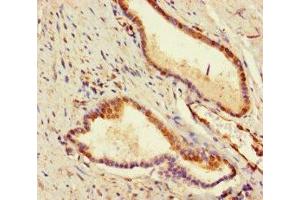 Immunohistochemistry of paraffin-embedded human prostate cancer using ABIN7177995 at dilution of 1:100 (ADCK2 抗体  (AA 200-609))