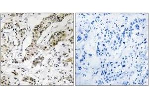 Immunohistochemistry analysis of paraffin-embedded human breast carcinoma, using TCEAL3/5/6 Antibody. (TCEAL3/5/6 抗体  (AA 141-190))