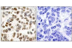 Immunohistochemical analysis of paraffin-embedded human breast carcinoma tissue, using BRCA1 (Ab-1423) antibody (E021234). (BRCA1 抗体)