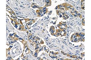 ABIN6258695 and ABIN6273499 at 1/100 staining human pancreatic cancer and adjacent non-tumor tissue by IHC-P. (TAB2 抗体  (Internal Region))