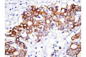 IHC-P: GCLC antibody testing of human rectal cancer tissue