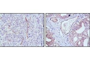 Immunohistochemical analysis of paraffin-embedded human stomach cancer (left) and ovary cancer (right) tissues using eNOS antibody with DAB staining. (ENOS 抗体)