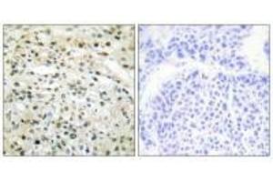 Immunohistochemistry analysis of paraffin-embedded human liver carcinoma tissue using DNMT3B antibody. (DNMT3B 抗体  (N-Term))