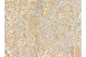 ABIN6262157 and ABIN6273254 at 1/100 staining human tongue carcinoma by IHC-P. (HBS1L 抗体  (N-Term))