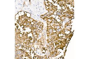 Immunohistochemistry of paraffin-embedded human lung squamous carcinoma tissue using TROP-2 Rabbit mAb (ABIN7271103) at dilution of 1:8100 (40x lens). (TACSTD2 抗体)