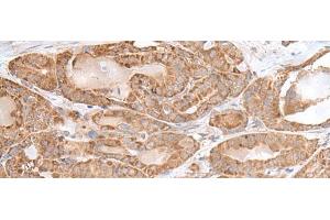 Immunohistochemistry of paraffin-embedded Human thyroid cancer tissue using RPL28 Polyclonal Antibody at dilution of 1:35(x200) (RPL28 抗体)
