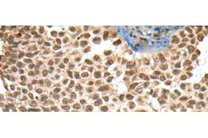Immunohistochemistry of paraffin-embedded Human ovarian cancer tissue using XPO1 Polyclonal Antibody at dilution of 1:40(x200) (XPO1 抗体)