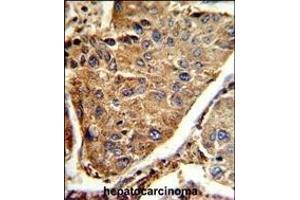 Formalin-fixed and paraffin-embedded human hepatocarcinoma reacted with HEXA Antibody (Center), which was peroxidase-conjugated to the secondary antibody, followed by DAB staining. (Hexosaminidase A 抗体  (AA 315-343))