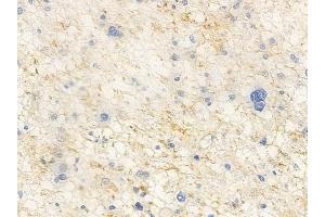 ABIN6265606 and ABIN6266929 at 1/100 staining human astrocytoma by IHC-P. (Anoctamin 7 抗体  (Internal Region))