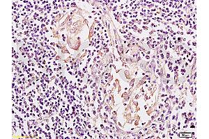 Formalin-fixed and paraffin embedded: human colon carcinoma labeled with Anti-Mesothelin Polyclonal Antibody, Unconjugated (ABIN727608) at 1:200, followed by conjugation to the secondary antibody and DAB staining (Mesothelin 抗体  (AA 101-200))