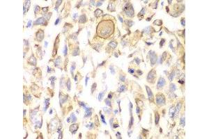 Immunohistochemistry of paraffin-embedded Human lung cancer using CD151 Polyclonal Antibody at dilution of 1:200 (40x lens). (CD151 抗体)