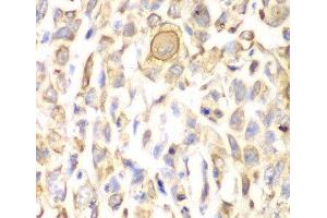 Immunohistochemistry of paraffin-embedded Human lung cancer using CD151 Polyclonal Antibody at dilution of 1:200 (40x lens).