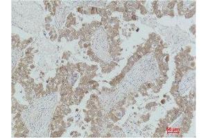 Immunohistochemistry (IHC) analysis of paraffin-embedded Human Lung Carcinoma using MEK-2 Polyclonal Antibody. (MEK2 抗体)