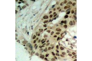 Immunohistochemical analysis of Exportin 5 staining in human ovarian cancer formalin fixed paraffin embedded tissue section. (XPO5 抗体)