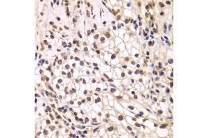 Immunohistochemistry of paraffin-embedded human kidney cancer using SMARCC1 antibody. (SMARCC1 抗体)