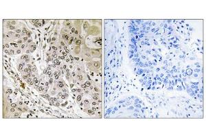 Immunohistochemistry analysis of paraffin-embedded human lung carcinoma tissue, using STK36 antibody. (STK36 抗体  (Internal Region))
