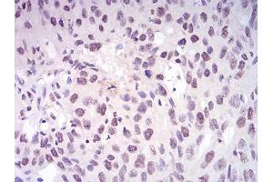 Immunohistochemical analysis of paraffin-embedded ovarian cancer tissues using DNMT1 mouse mAb with DAB staining. (DNMT1 抗体  (AA 1317-1616))