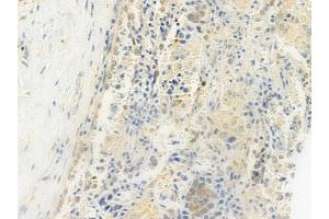 ABIN6264684 and ABIN6279171 at 1/100 staining human lung squamous cell carcinoma by IHC-P. (RECQL4 抗体  (Internal Region))