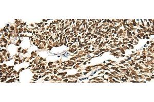 Immunohistochemistry of paraffin-embedded Human lung cancer tissue using MORF4L2 Polyclonal Antibody at dilution of 1:25(x200) (MORF4L2 抗体)