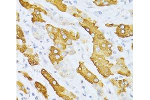 Immunohistochemistry of paraffin-embedded Human liver cancer using CYP2E1 Polyclonal Antibody at dilution of 1:100 (40x lens). (CYP2E1 抗体)