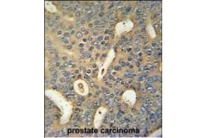 MICALL1 Antibody (C-term) (ABIN654455 and ABIN2844189) immunohistochemistry analysis in formalin fixed and paraffin embedded human prostate carcinoma followed by peroxidase conjugation of the secondary antibody and DAB staining. (MICAL-Like 1 抗体  (C-Term))