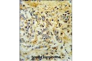 LMBR1L Antibody (C-term) (ABIN653751 and ABIN2843051) IHC analysis in formalin fixed and paraffin embedded breast carcinoma followed by peroxidase conjugation of the secondary antibody and DAB staining. (LMBR1L 抗体  (C-Term))