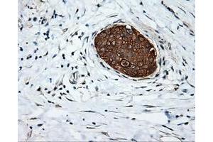 Immunohistochemical staining of paraffin-embedded Adenocarcinoma of colon tissue using anti-SRR mouse monoclonal antibody. (SRR 抗体)