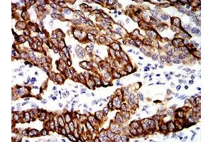 Immunohistochemistry (IHC) image for anti-Keratin 19 (KRT19) (AA 274-400) antibody (ABIN5542469)