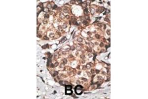 Formalin-fixed and paraffin-embedded human cancer tissue reacted with the primary antibody, which was peroxidase-conjugated to the secondary antibody, followed by DAB staining.