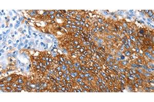 Immunohistochemistry of paraffin-embedded Human lung cancer using SNX5 Polyclonal Antibody at dilution of 1:30 (SNX5 抗体)