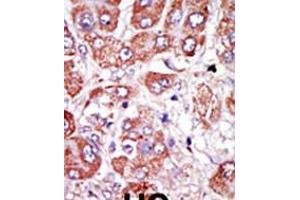 Formalin-fixed and paraffin-embedded human cancer tissue reacted with the primary antibody, which was peroxidase-conjugated to the secondary antibody, followed by DAB staining. (PLAU 抗体  (AA 136-166))