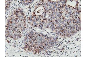 Immunohistochemical staining of paraffin-embedded Carcinoma of Human lung tissue using anti-NMT2 mouse monoclonal antibody. (NMT2 抗体)