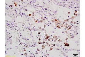 Formalin-fixed and paraffin embedded human lung carcinoma labeled with Anti-ELK1 Polyclonal Antibody, Unconjugated (ABIN685972) at 1:200 followed by conjugation to the secondary antibody and DAB staining. (ELK1 抗体  (AA 301-428))