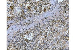 IHC analysis of Carbonic Anhydrase 9/CA9 using anti-Carbonic Anhydrase 9/CA9 antibody (ABIN7600076). (CA9 抗体  (AA 146-414))