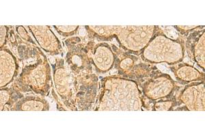 Immunohistochemistry of paraffin-embedded Human thyroid cancer tissue using HORMAD2 Polyclonal Antibody at dilution of 1:45(x200) (HORMAD2 抗体)