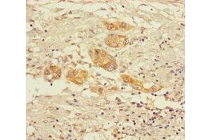 Immunohistochemistry of paraffin-embedded human pancreatic cancer using ABIN7142162 at dilution of 1:100 (alpha KGDHC 抗体  (AA 41-423))