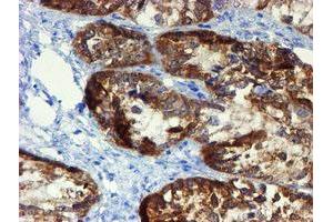 Immunohistochemical staining of paraffin-embedded Adenocarcinoma of Human ovary tissue using anti-DOK7 mouse monoclonal antibody. (DOK7 抗体)