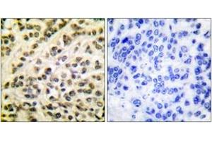 Immunohistochemistry analysis of paraffin-embedded human breast carcinoma tissue, using FLI1 Antibody. (FLI1 抗体  (AA 291-340))