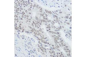 Immunohistochemistry of paraffin-embedded human colon carcinoma using XRCC1 Rabbit pAb (ABIN1683300, ABIN5663662, ABIN5663663, ABIN5663664 and ABIN6213850) at dilution of 1:300 (40x lens). (XRCC1 抗体  (AA 1-320))