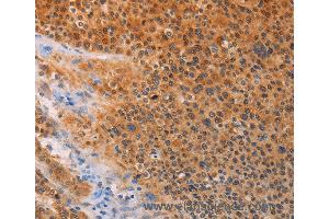 Immunohistochemistry of Human lung cancer using ADHFE1 Polyclonal Antibody at dilution of 1:30 (ADHFE1 抗体)