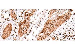 Immunohistochemistry of paraffin-embedded Human esophagus cancer tissue using AK9 Polyclonal Antibody at dilution of 1:60(x200)