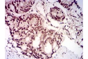Immunohistochemical analysis of paraffin-embedded colon cancer tissues using AKT1S1 mouse mAb with DAB staining.