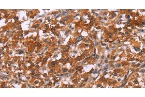 Immunohistochemistry of paraffin-embedded Human thyroid cancer tissue using HSPB6 Polyclonal Antibody at dilution 1:30 (HSPB6 抗体)