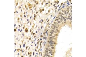 Immunohistochemistry of paraffin-embedded human uterine cancer using DNMT3A Antibody (ABIN1872325) at dilution of 1:100 (40x lens). (DNMT3A 抗体)