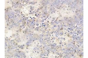 ABIN6255657 and ABIN6267507 at 1/100 staining human melanoma by IHC-P.